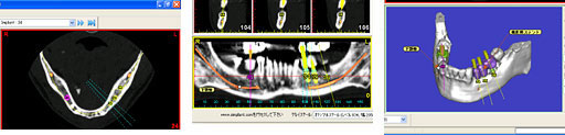 インプラント手術などの際、CT撮影による術前シュミレーションが可能です。