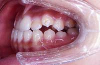 矯正歯科1－術前
