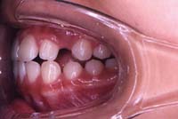 矯正歯科2－術前