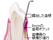 歯4