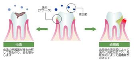 虫歯・歯周病