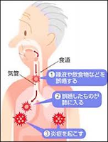 誤嚥性肺炎No2